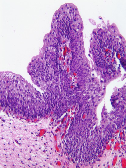 papilloma urothelial histopathology hpv impfung manner bkk vbu