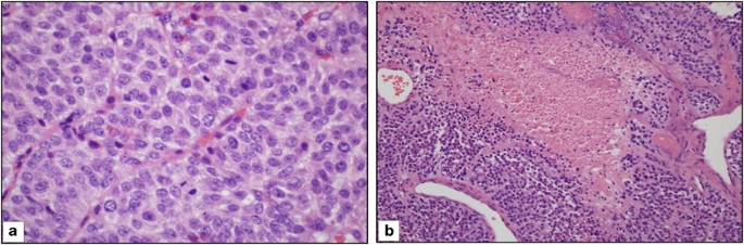 Adrenal cortical tumors, pheochromocytomas and paragangliomas | Modern  Pathology