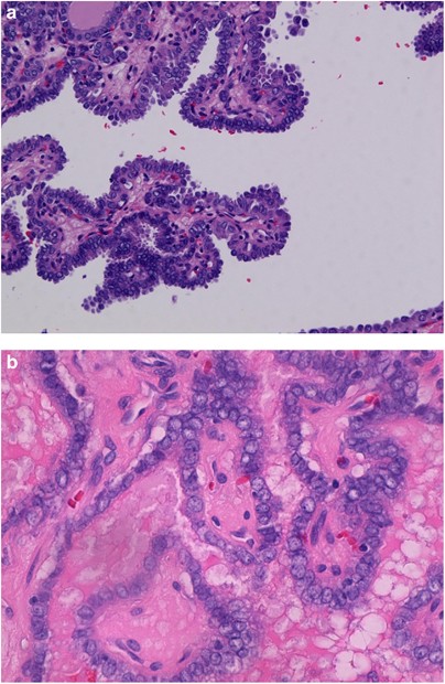 papillary thyroid carcinoma gross