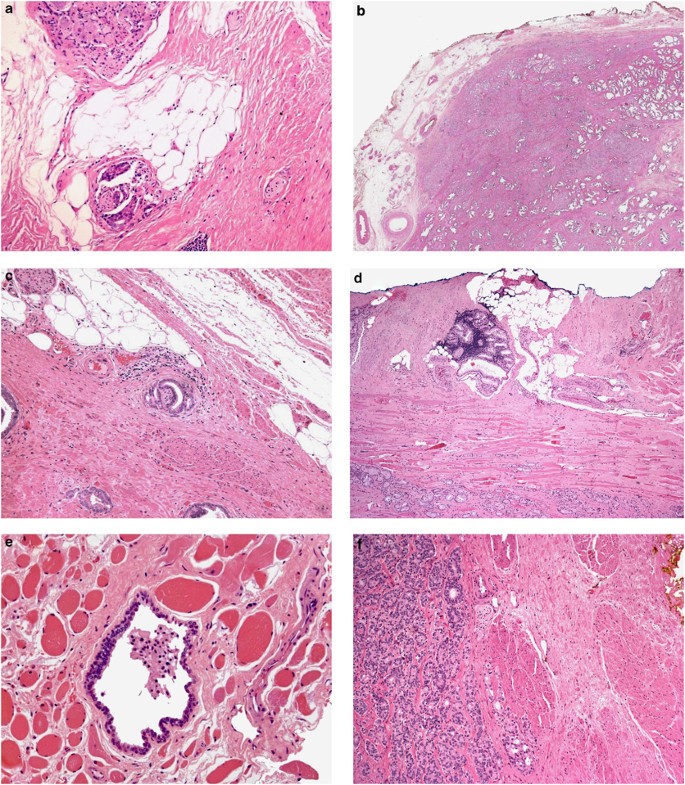 bladder neck involvement prostate cancer A kezelési prosztatitis termoterápiája