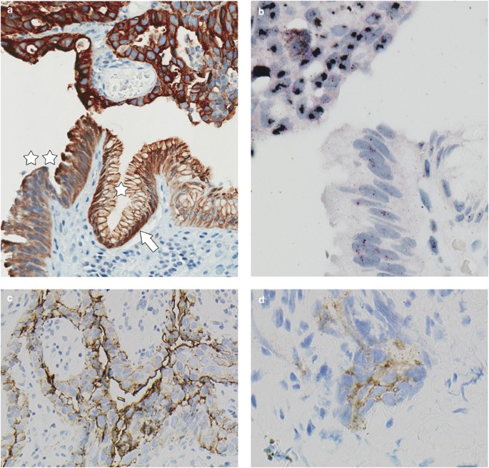 inverted papilloma papillary tumor