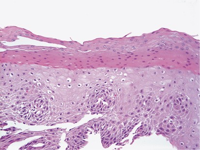 esophageal ulcer histology