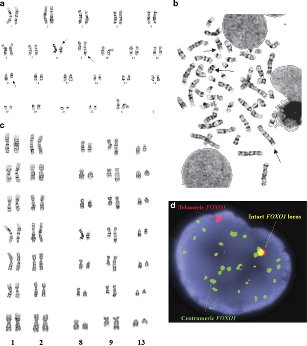 FOXO1–FGFR1