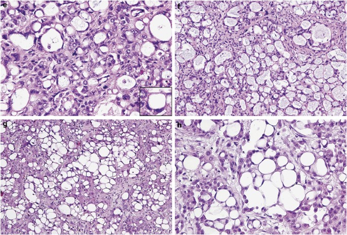 Mesothelioma with signet-ring cell features: report of 23 cases | Modern  Pathology