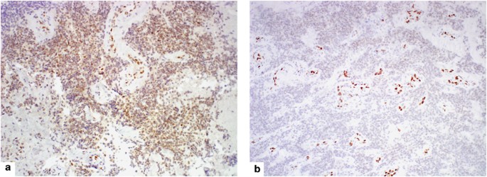 Expression of ERG, an Ets family transcription factor, identifies  ERG-rearranged Ewing sarcoma | Modern Pathology