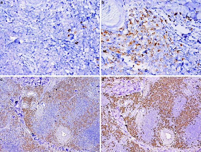 Primary cutaneous marginal zone lymphomas with plasmacytic differentiation  show frequent IgG4 expression | Modern Pathology