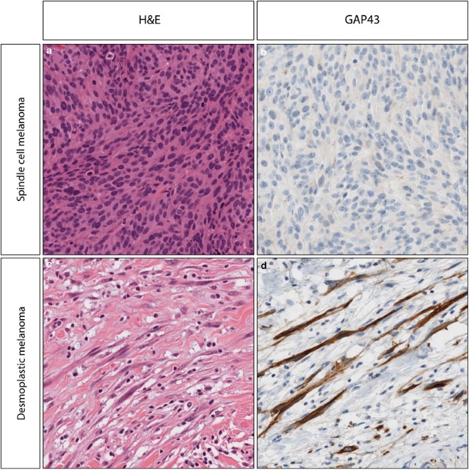 Growth-associated protein 43 in differentiating peripheral nerve sheath tumors from other non-neural spindle cell neoplasms | Modern Pathology Growth-associated protein 43 in differentiating peripheral nerve sheath tumors from other non-neural spindle cell neoplasms | Modern Pathology