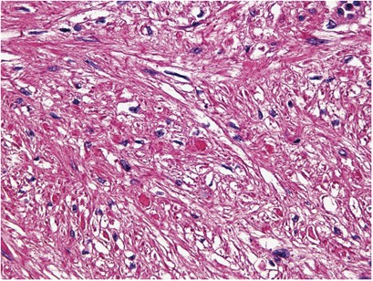 benign cancer of smooth muscle