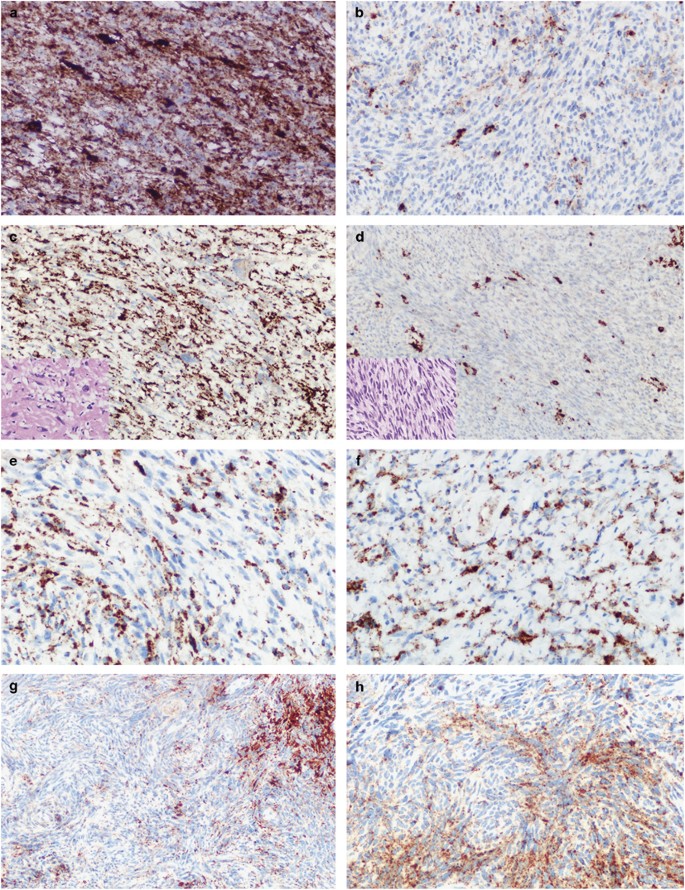 melanotic streaking Melanonychia: Clues for Diagnosis and the Importance of Histology