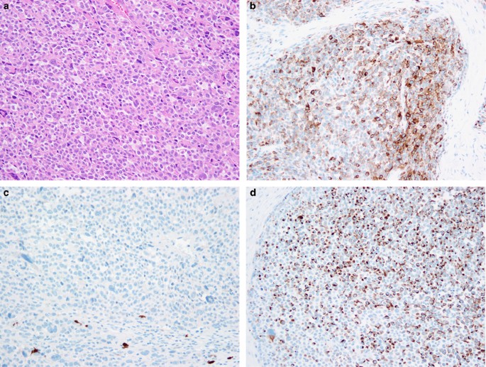 Aberrant intermediate filament and synaptophysin expression is a frequent  event in malignant melanoma: an immunohistochemical study of 73 cases |  Modern Pathology