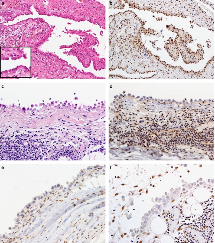 Bap1 Brca1 Associated Protein 1 Is A Highly Specific Marker For Differentiating Mesothelioma From Reactive Mesothelial Proliferations Modern Pathology