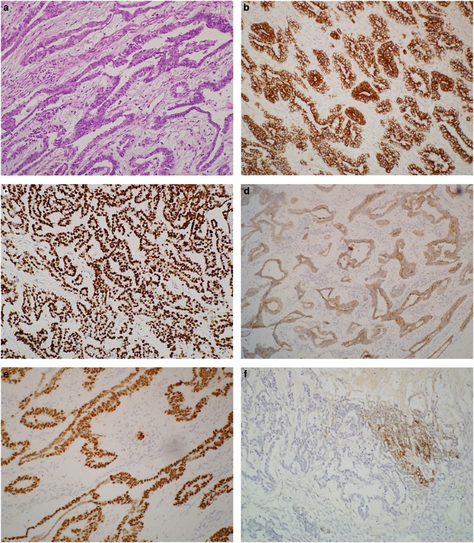 Unity ticket shop High-level expression of divergent endodermal lineage markers in gonadal  and extra-gonadal yolk sac tumors | Modern Pathology