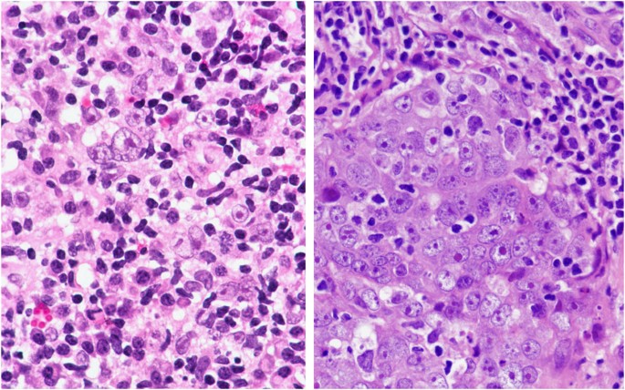 nasopharyngeal carcinoma histology