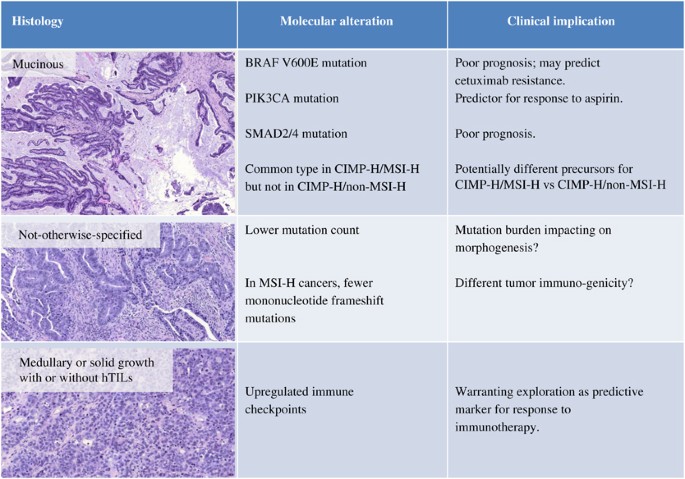rectal cancer histopathology