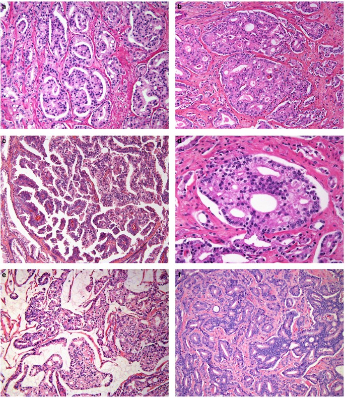 adenocarcinoma prostate gleason 6 33))