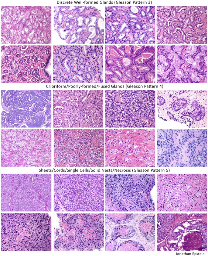 prostatic adenocarcinoma gleason score 45= 9)