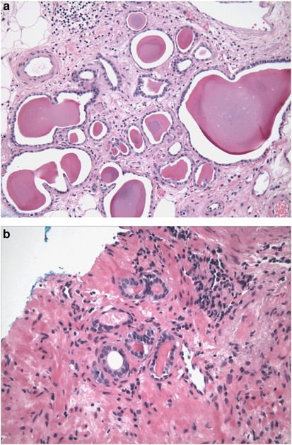 prostatic atrophy histology)