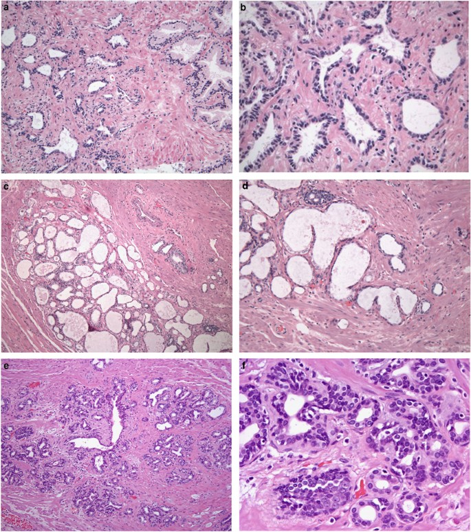 prostate atrophy causes