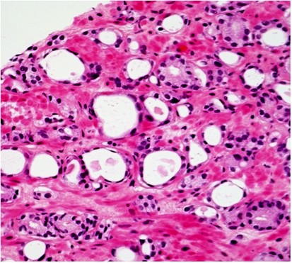 invasive prostatic adenocarcinoma acinar type