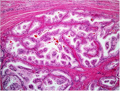 prostatic adenocarcinoma small acinar type