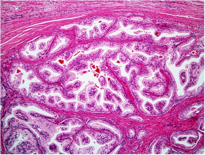 prostate adenocarcinoma acinar type anatomia de prostata zonas