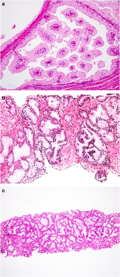 Formon prosztatitis Gyertyák propolis- val a prostatitis listából