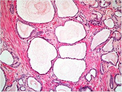 prostatic adenocarcinoma conventional/ acinar type prosztata betegség lelki okai