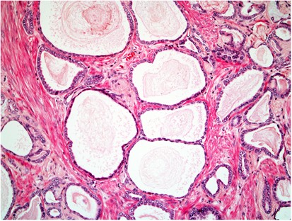 Acinaris adenocarcinoma, Prosztatarák