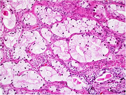 prostatic adenocarcinoma conventional acinar type