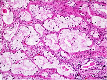 a prosztatitis gyógyulása bacteria prostatitis causes