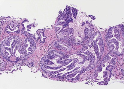 High-grade prostatic intraepithelial neoplasia, PIN-like carcinoma, ductal  carcinoma, and intraductal carcinoma of the prostate | Modern Pathology