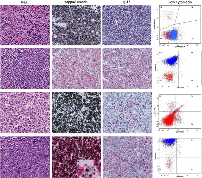 Ultrasensitive automated RNA in situ hybridization for kappa and lambda  light chain mRNA detects B-cell clonality in tissue biopsies with  performance comparable or superior to flow cytometry | Modern Pathology