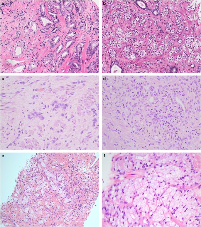 prostate cancer treatment effect histology a krónikus prosztatitis kezelésére szolgáló rendszer