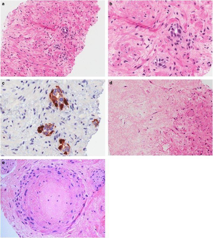 prostate cancer treatment effect histology