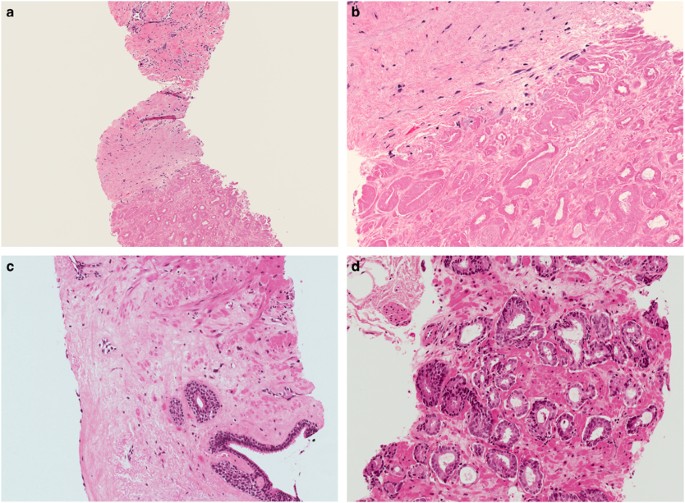 prostate cancer treatment effect histology prostatitis és tejtermékek