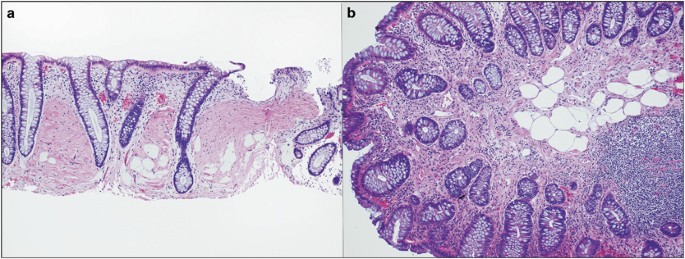 Intramucosal lipomas of the colon implicate Cowden syndrome | Modern  Pathology