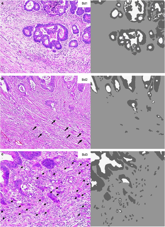 Recommendations For Reporting Tumor Budding In Colorectal Cancer Based On The International Tumor Budding Consensus Conference Itbcc 16 Modern Pathology