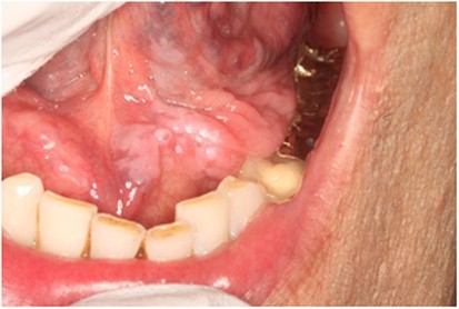 human papillomavirus infection dental)