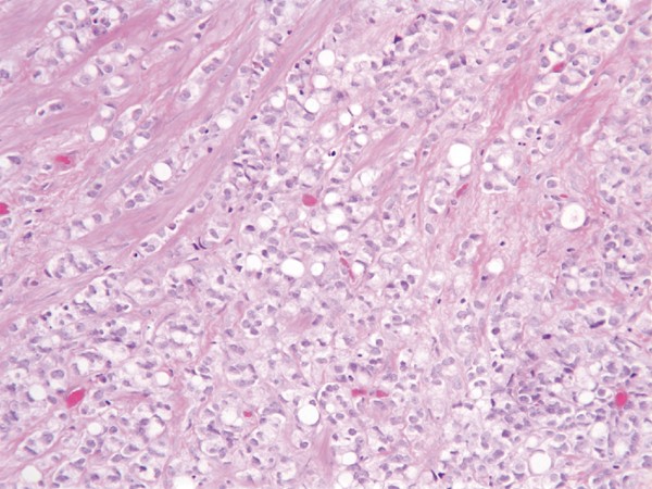 prostatic acinar adenocarcinoma pathology outlines mit jelent a krónikus prosztatitis