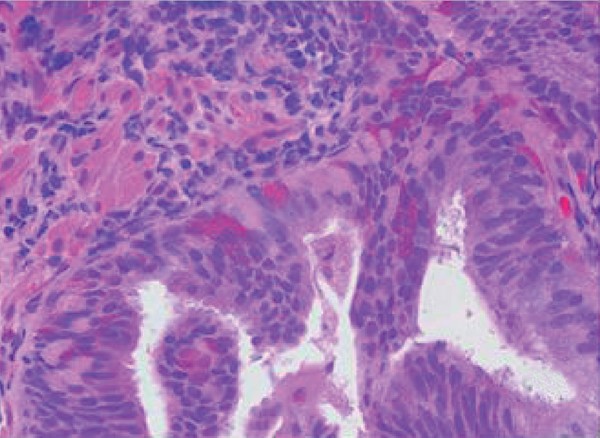 High-grade prostatic intraepithelial neoplasia | Modern Pathology