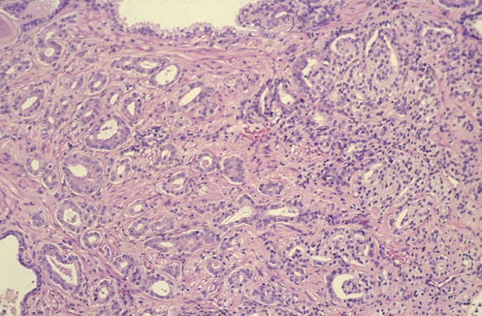 Gleason grading and prognostic factors in carcinoma of the prostate |  Modern Pathology