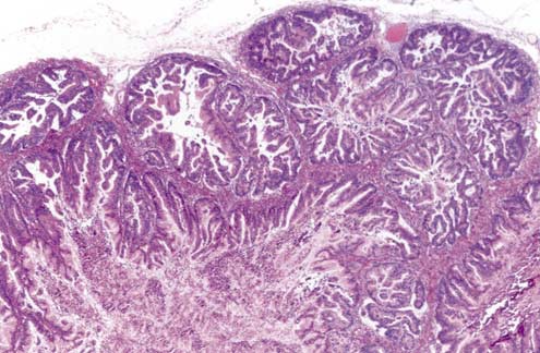 Ovarian cancer mucinous, Cum să eliminați anunțurile pentru viermi - Ovarian cancer mucinous