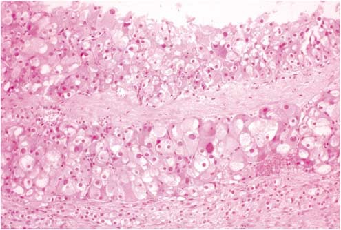 ovarian cyst histology