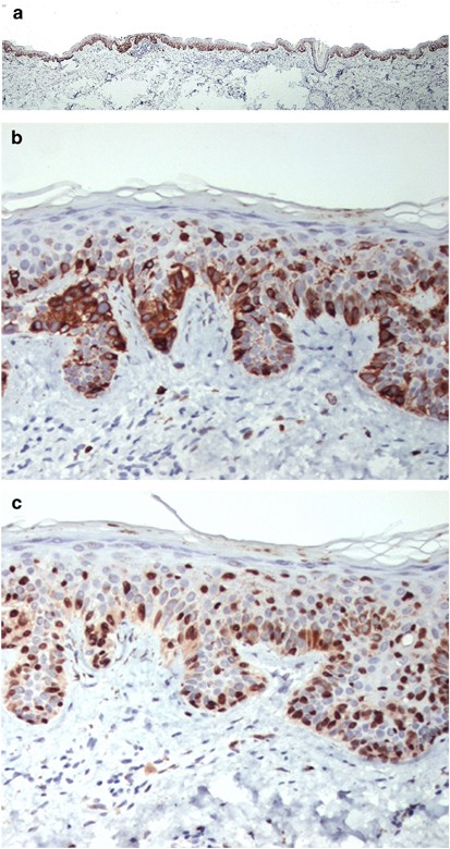 lentigenous melanotic hyperplasia Lentiginous melanoma: a histologic pattern of melanoma to be distinguished  from lentiginous nevus