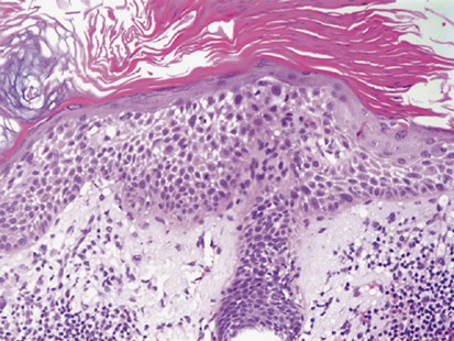 squamous cell carcinoma in situ histology