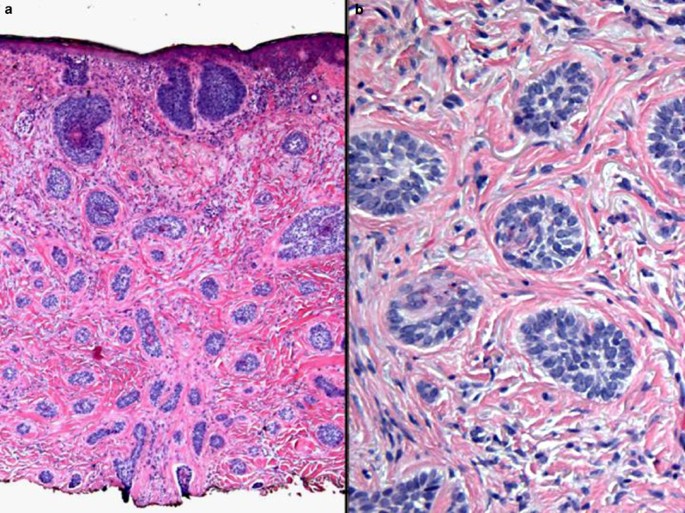 Basal Cell Carcinoma Biology Morphology And Clinical