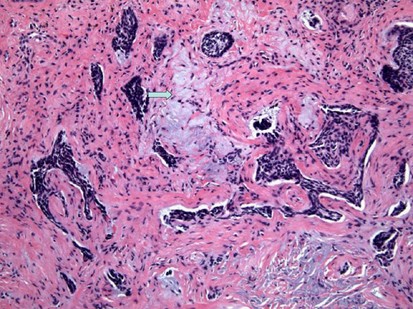 morpheaform basal cell carcinoma histology