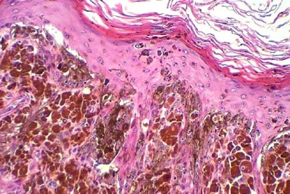 Unusual Variants Of Malignant Melanoma Modern Pathology Unusual Variants Of Malignant Melanoma Modern Pathology