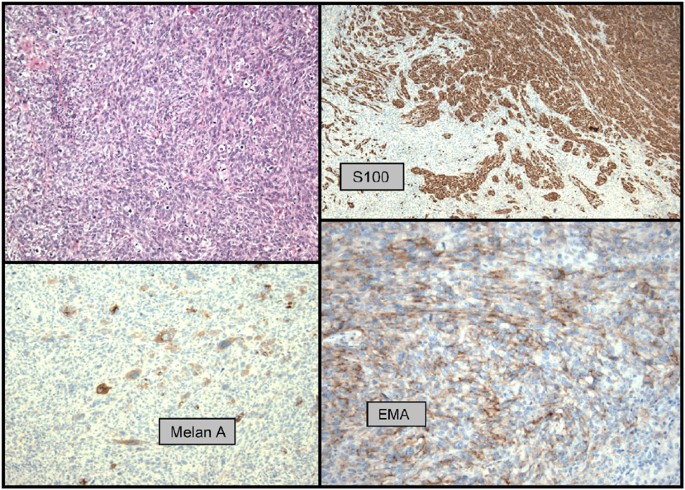 Unusual variants of malignant melanoma | Modern Pathology