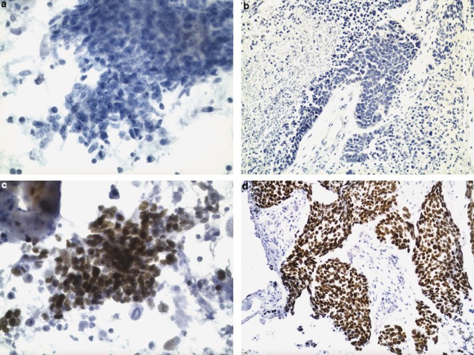 TTF-1 and p63 for distinguishing pulmonary small-cell carcinoma from poorly  differentiated squamous cell carcinoma in previously pap-stained cytologic  material | Modern Pathology